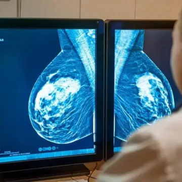 Innovación mejora expectativa de vida en pacientes de cáncer de mama metastásico
