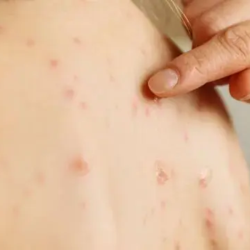 Sociedad Dermatología pide ciudadanía no automedicarse por sarampión