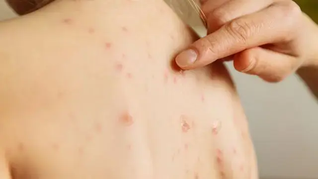 Sociedad Dermatología pide ciudadanía no automedicarse por sarampión